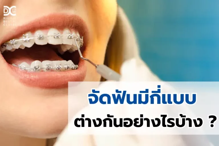 จัดฟันมีกี่แบบและต่างกันอย่างไร