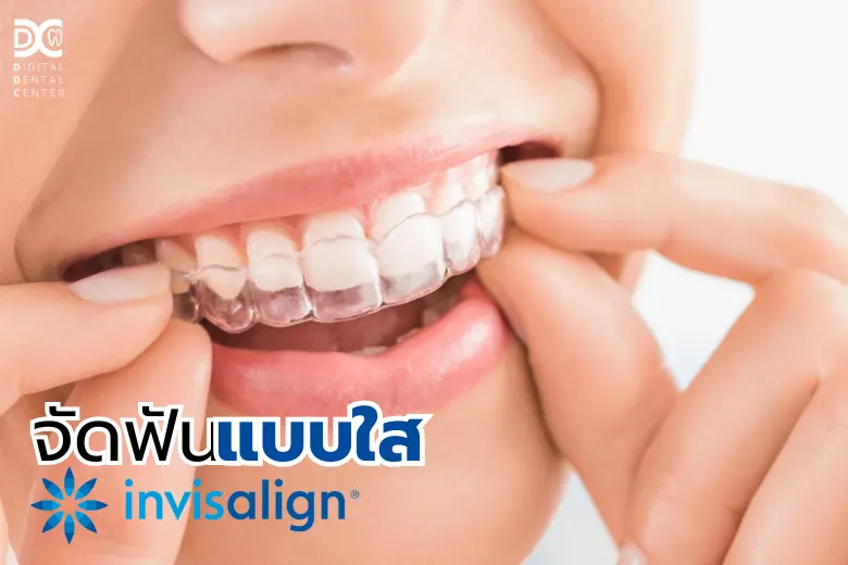 จัดฟันแบบใสด้วย Invisalign