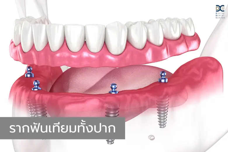 รากฟันเทียมสำหรับฟันปลอม