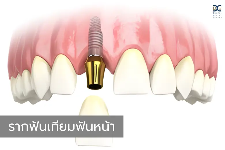 รากฟันเทียมสำหรับการฟื้นฟู