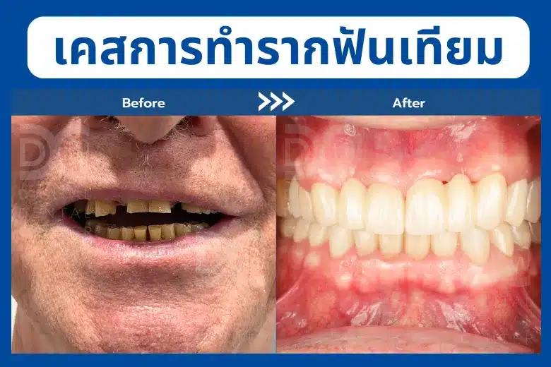 Before After Denatl Implant Osstem 