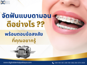 จัดฟันแบบดามอนดีอย่างไร