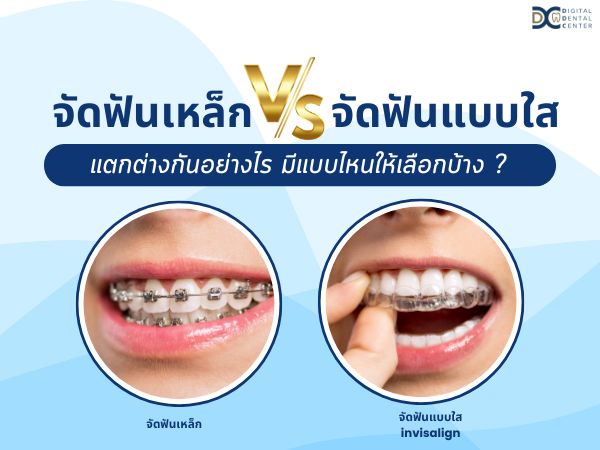 จัดฟันรอบสอง, Digital Dental Center Pattaya, คลินิกทันตกรรม, จัดฟันใส, รอยยิ้มสวย, ฟันสวย