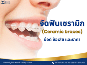 รูปภาพของคนไข้ที่กำลังยิ้มพร้อมติดเครื่องมือจัดฟันเซรามิก (Ceramic braces) ที่มองเห็นได้น้อยและกลมกลืนกับสีฟัน พร้อมข้อความ "จัดฟันเซรามิก (Ceramic braces) ข้อดี ข้อเสีย และราคา" จาก Digital Dental Center Pattaya