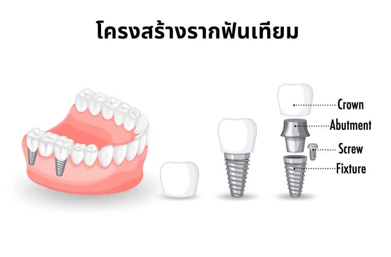 โครงสร้างรากฟันเทียม,องประกอบรากฟันเทียม