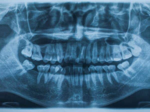 ขั้นตอนการ x-ray ฟัน