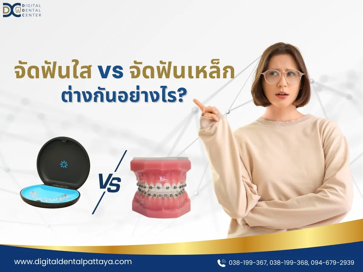 จัดฟันใสกับจัดฟันเหล็ก แบบไหนดีกว่ากัน ดูข้อแตกต่างที่นี่